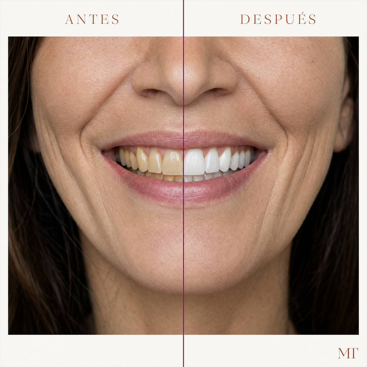 Antes y después en una mujer de 45 años: dientes menos amarillos