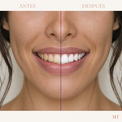Antes y después en una mujer joven: dientes menos amarillos