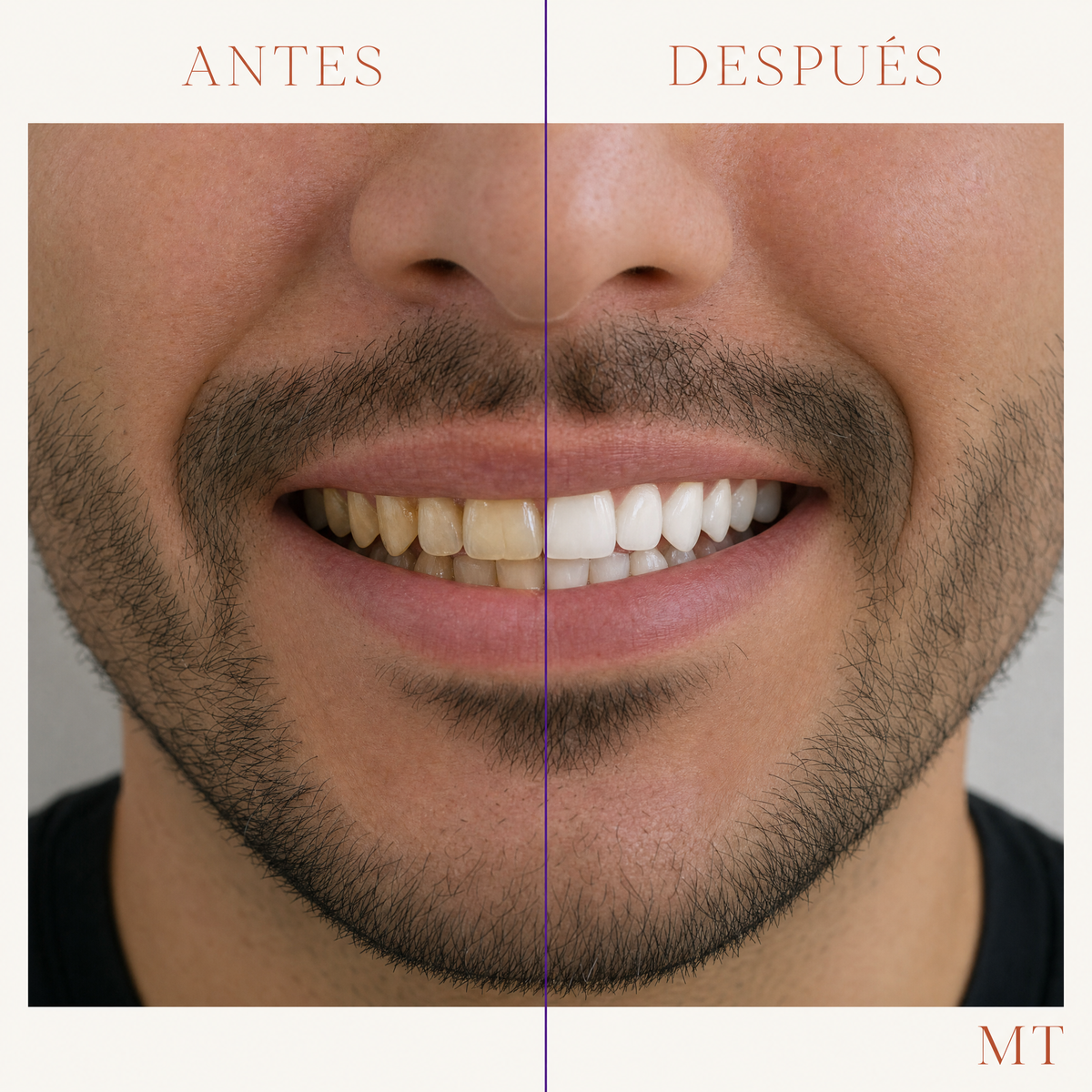 Antes y después en un hombre: dientes menos amarillos